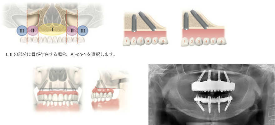 オールオン4の説明