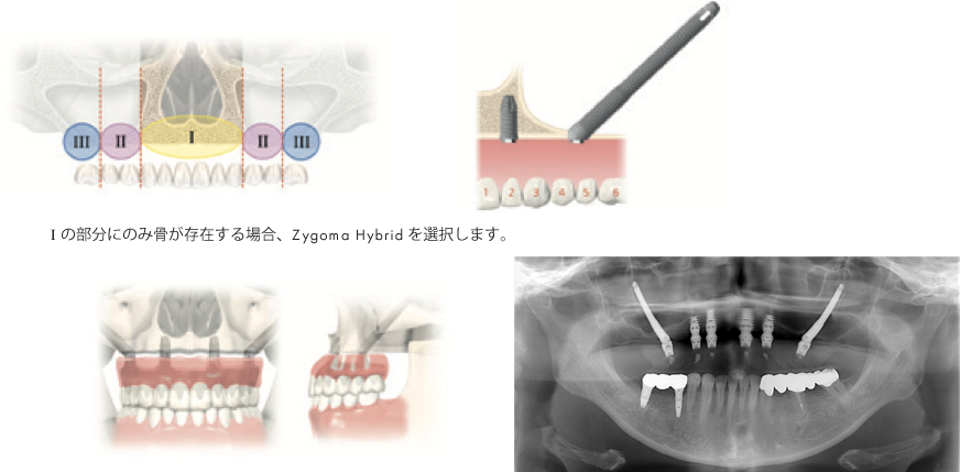 Zygoma-Hybridの説明