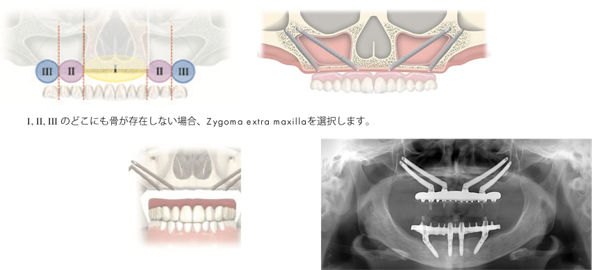Zygoma-Hybridの説明