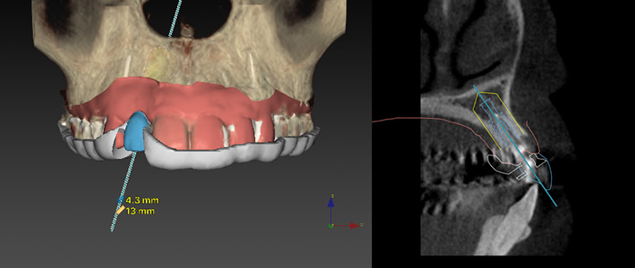 Nobel Clinician による3Dプランニング