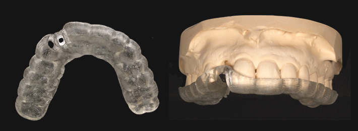 Nobel Clinician による3Dプランニング