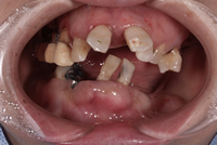 歯周病例3
